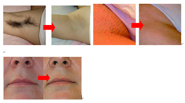 Haar-Reduzierungs-Hochleistung IPLs dauerhafte, intensiver pulsierter heller Haar-Entferner