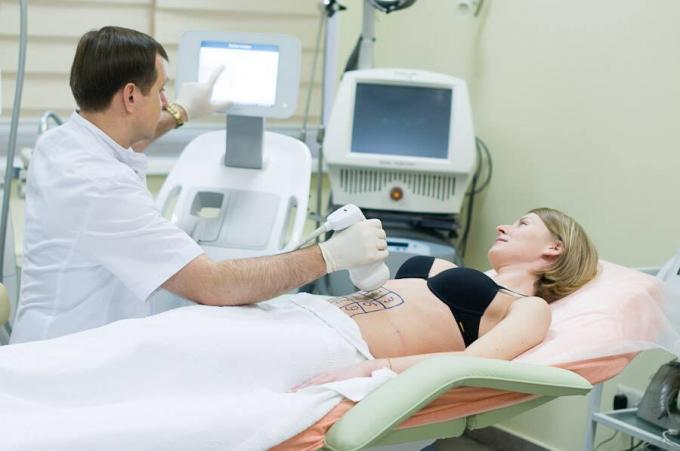Nicht Invasionskörper, der Ultraschallfettabsaugungs-Hohlraumbildung Rf abnimmt Maschine Liposonix umreißt