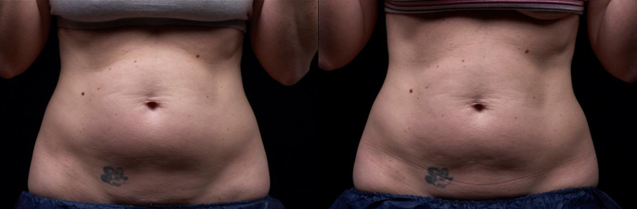 Nicht Invasionskörper, der Ultraschallfettabsaugungs-Hohlraumbildung Rf abnimmt Maschine Liposonix umreißt