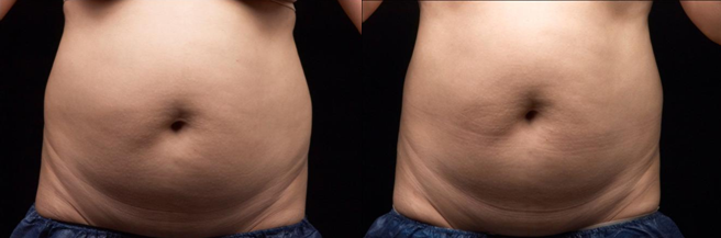 Nicht Invasionskörper, der Ultraschallfettabsaugungs-Hohlraumbildung Rf abnimmt Maschine Liposonix umreißt