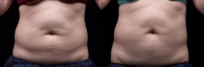 Nicht Invasionskörper, der Ultraschallfettabsaugungs-Hohlraumbildung Rf abnimmt Maschine Liposonix umreißt