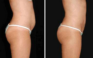 Frauen-Gesichtsbehandlung/Körper/Arm Fettsäuren Lipo-Hohlraumbildung bearbeiten Ultraschallvakuumbruch-Rf maschinell
