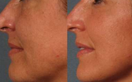 Frauen-Gesichtsbehandlung/Körper/Arm Fettsäuren Lipo-Hohlraumbildung bearbeiten Ultraschallvakuumbruch-Rf maschinell