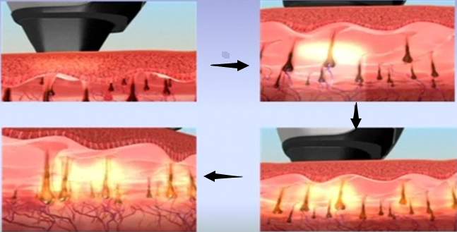Laser der Frauen-Multifunktionsschönheits-Maschinen-1064 Nanometer Nd-Yag, Tätowierungs-Laser-Abbau-Ausrüstungen