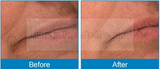 Dioden-Laser-Haar-Abbau-Maschinen-schmerzlose Haar-Abbau-Ausrüstungen der Enthaarungs-Schönheits-808nm