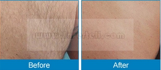 Dioden-Laser-Haar-Abbau-Maschinen-schmerzlose Haar-Abbau-Ausrüstungen der Enthaarungs-Schönheits-808nm
