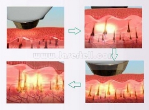 Dioden-Laser-Haar-Abbau-Maschinen-schmerzlose Haar-Abbau-Ausrüstungen der Enthaarungs-Schönheits-808nm