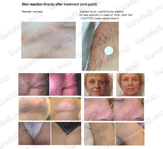 Stelle 5Hz Alexandrite-Laser-Maschine, Laser-Haar-Abbau-Ausrüstung mit LCD Displasy