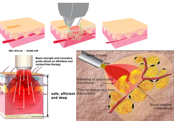 rote Laser-Spinnen-Ader-Abbau-Maschinen-schmerzlose Hochfrequenz 30MHZ der Dioden-635nm
