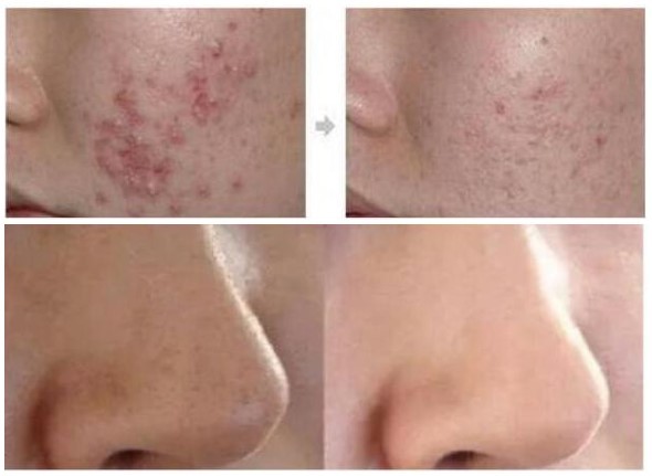 Super Saugwasser Dermabrasion Schale mit 3 Flaschen Hydro Dermabrasion (CE)