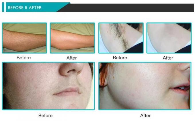 Hairfree 808 Wellenlängen Nanometer IPL Laser-Maschinen-3 für alle nette Farbhaut
